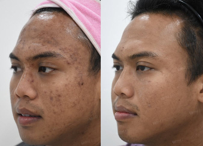 Before and After Treatment