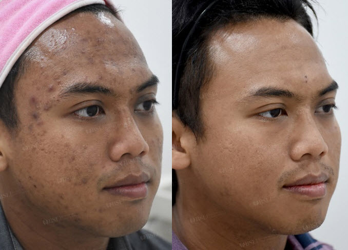 Before and After Treatment