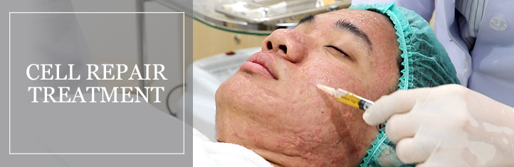 Potential Effects of Laser Treatment for Pitted Scarring