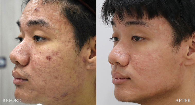 before and after treatment