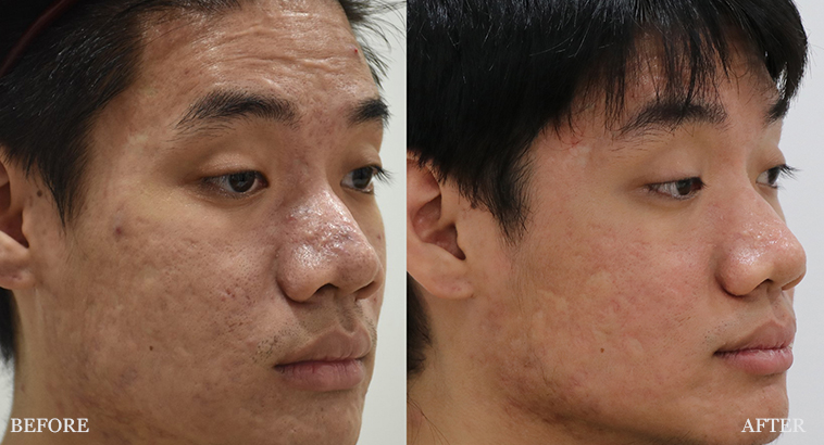 before and after treatment