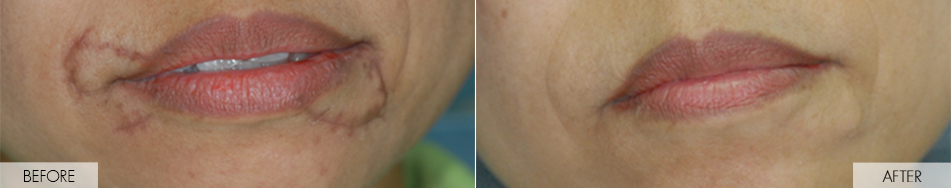 before and after treatment