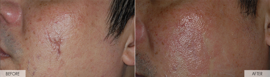 before and after treatment