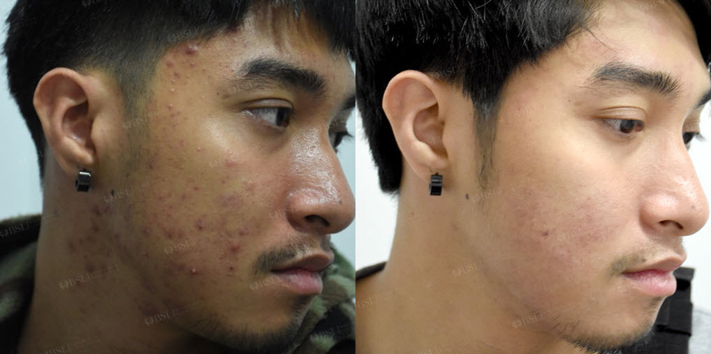 Before and After Treatment