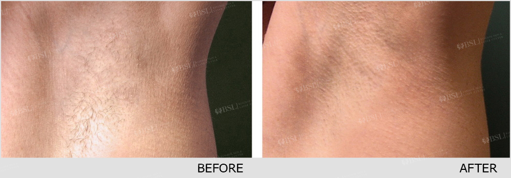 result Remove Underarm Hair