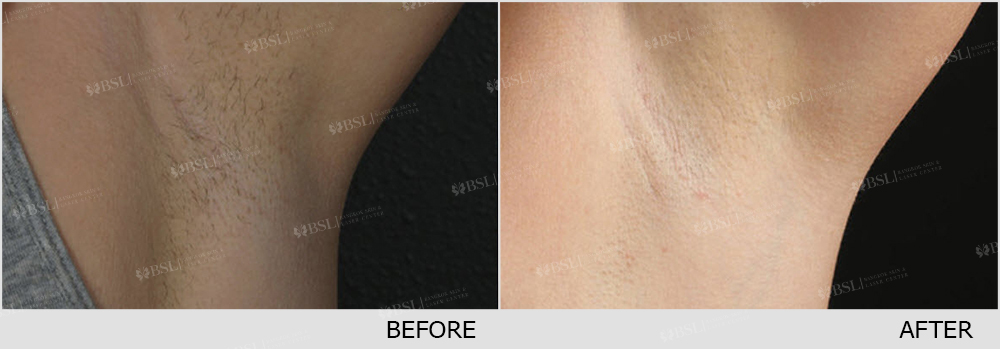 result Remove Underarm Hair