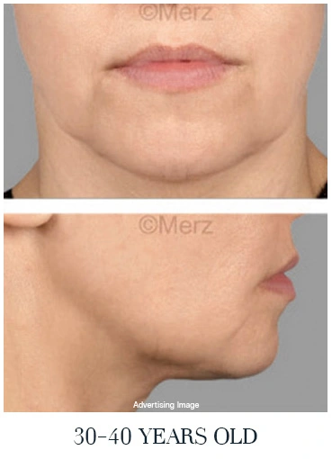 face lift age 30s skin beginning to loosen jawline softening before and after skin firmness