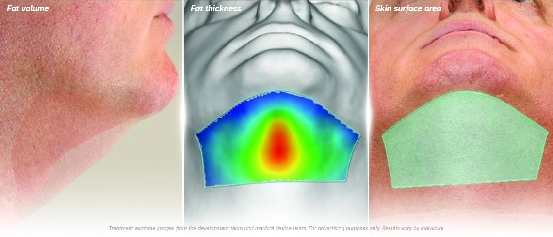 3d volumetric scan submental fat reduction coolshaping2 fat freezing results non surgical body contouring
