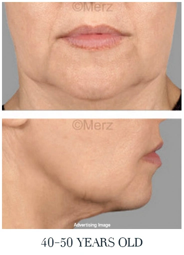 moderate skin sagging 40s face lift options for midlife jawline laxity facial aging signs