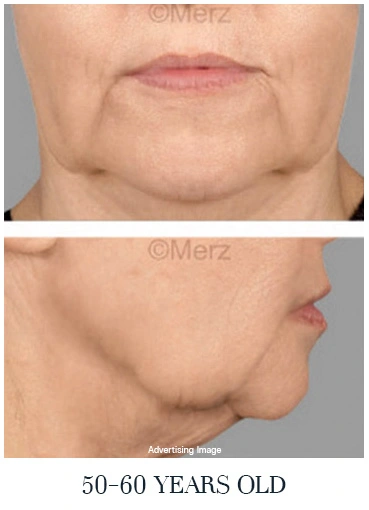 advanced facial laxity 50s face lift treatment reference loose skin neck jaw aging process