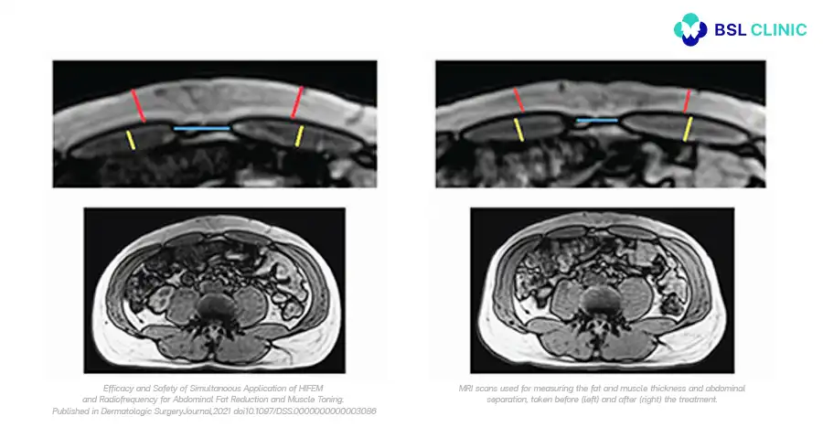 Abdominal Contouring — Multicenter MRI Study