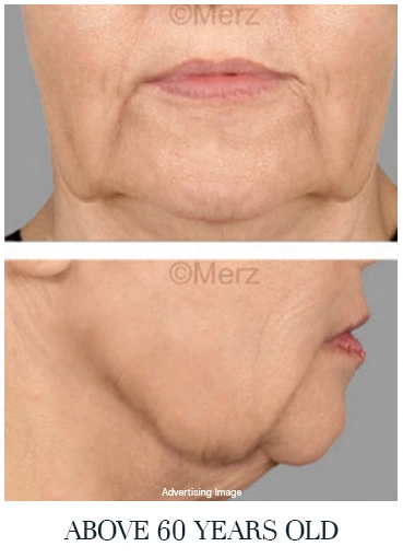 severe skin sagging senior age face lift before photo neck jowl laxity skin firmness decline