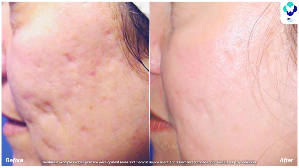 result fraxel dual laser