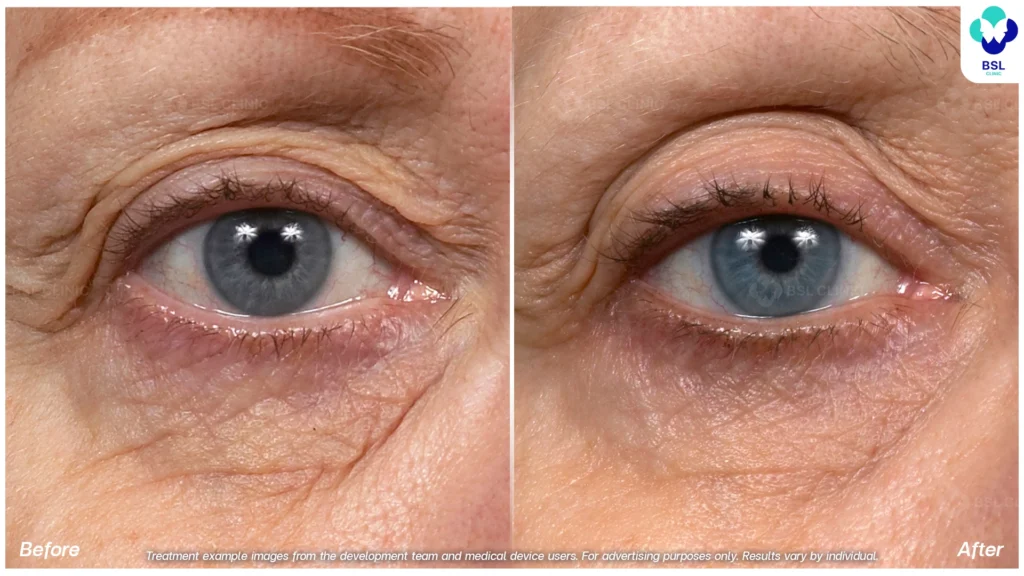 before after Thermage younger