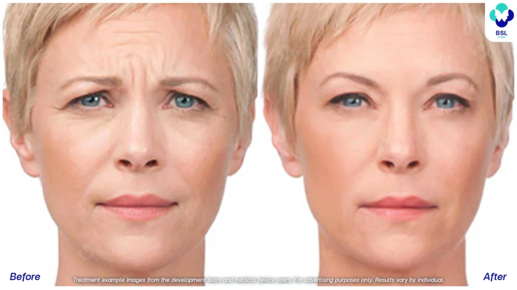 result Wrinkle Treatment