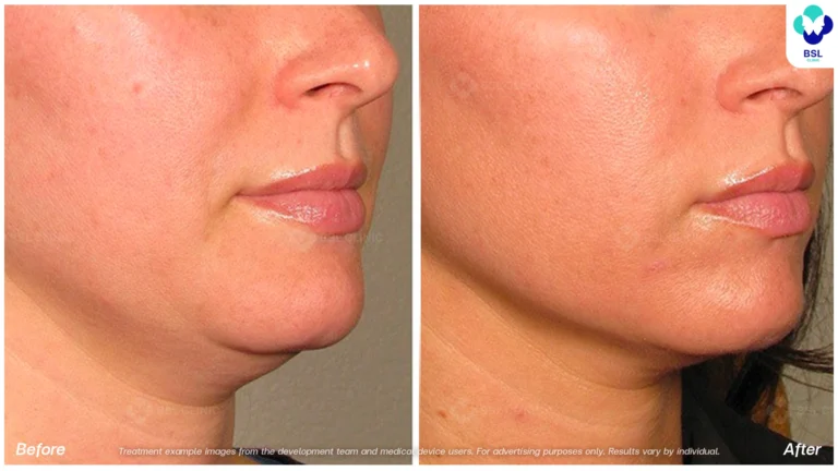 BA-result-Ulthera-Chin-and-Jawline-04.webp