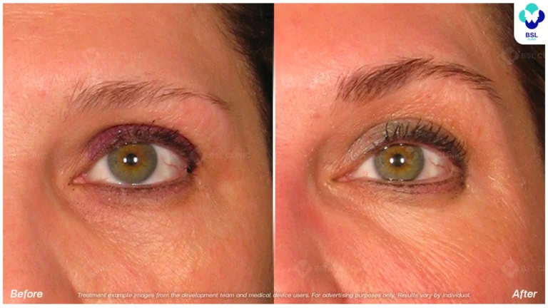 BA-result-Ulthera-Eyebrows-03.webp