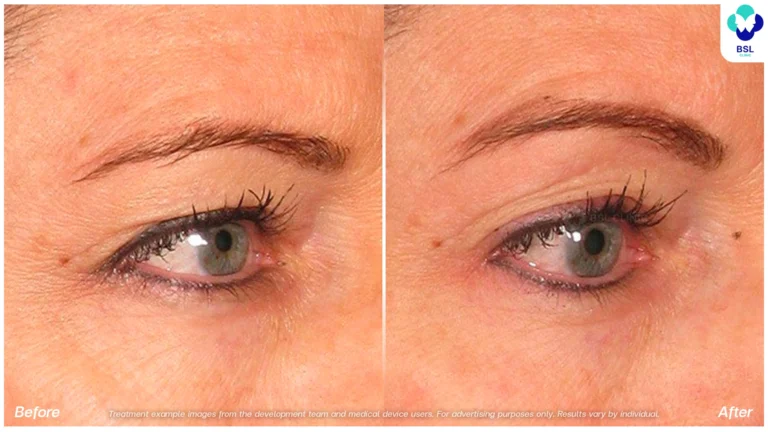 BA-result-Ulthera-Eyebrows-05.webp