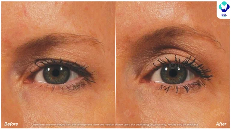 BA-result-Ulthera-Eyebrows-07.webp