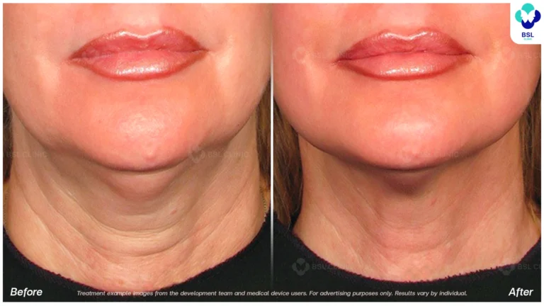 BA-result-Ulthera-Neck-01.webp