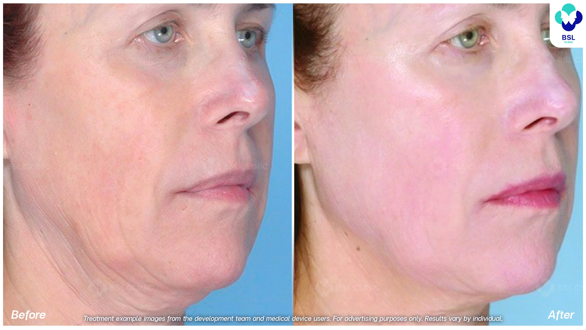 BA-result-face-lift-03.webp