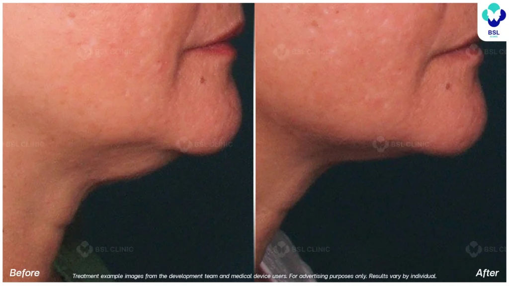 result face lift