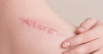 Scar Removal Treatments