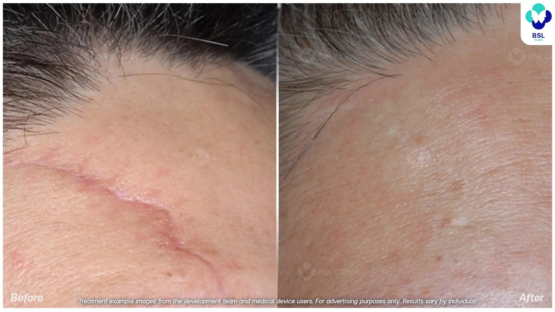 Before After แผลเป็น