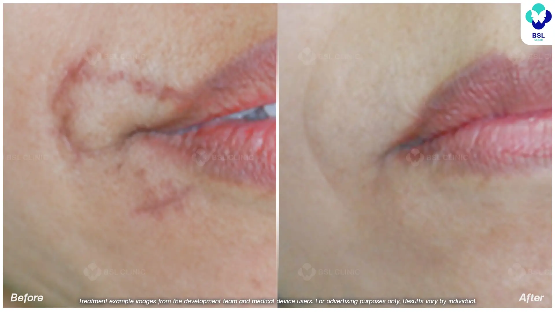 Before After แผลเป็น