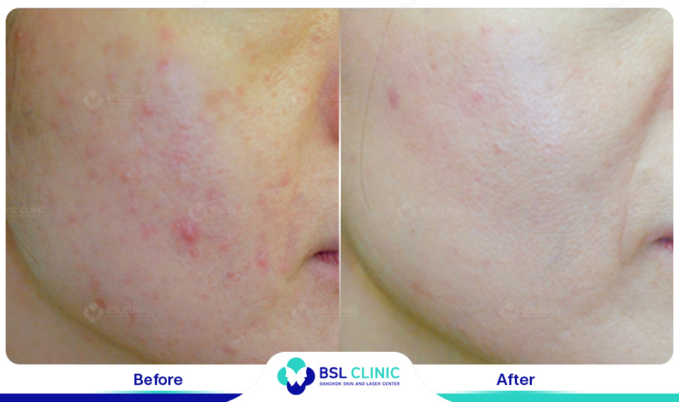 Before and After Treatments of Seborrheic Dermatitis