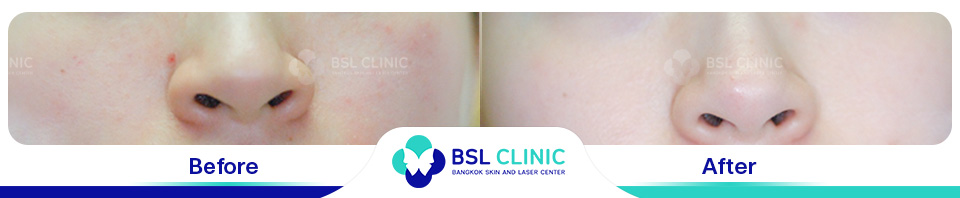 Before and After Treatments of Seborrheic Dermatitis