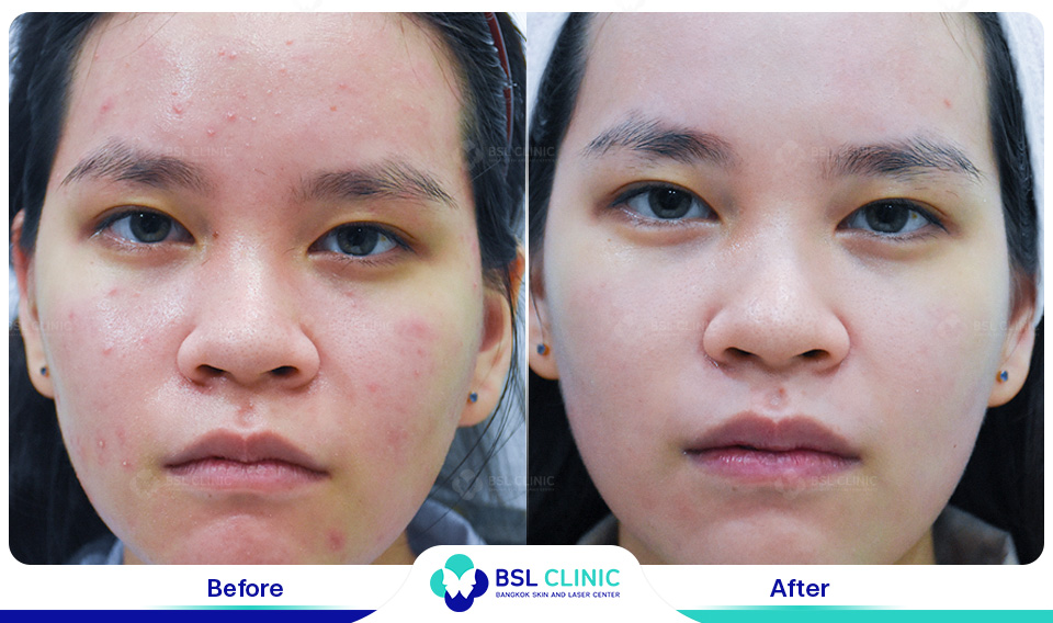 Before and After Treatments of Seborrheic Dermatitis