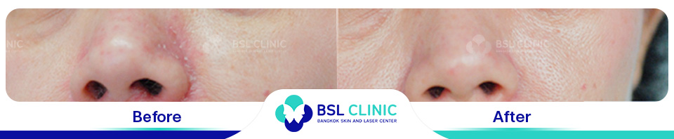 Before and After Treatments of Seborrheic Dermatitis