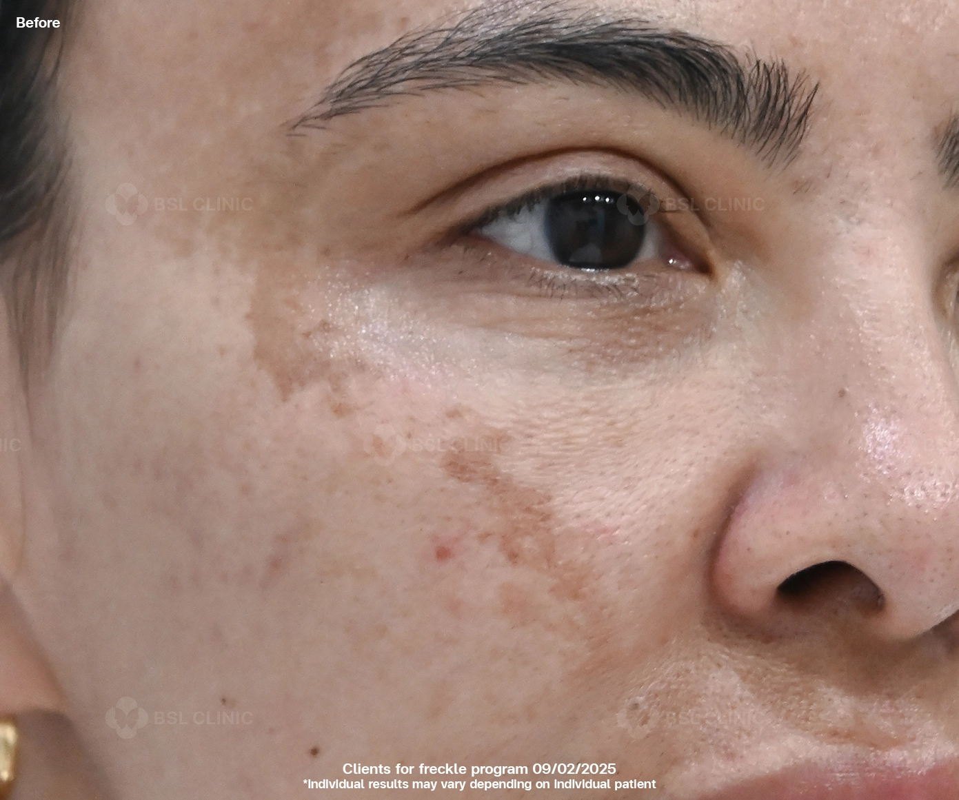 Before result Frekle