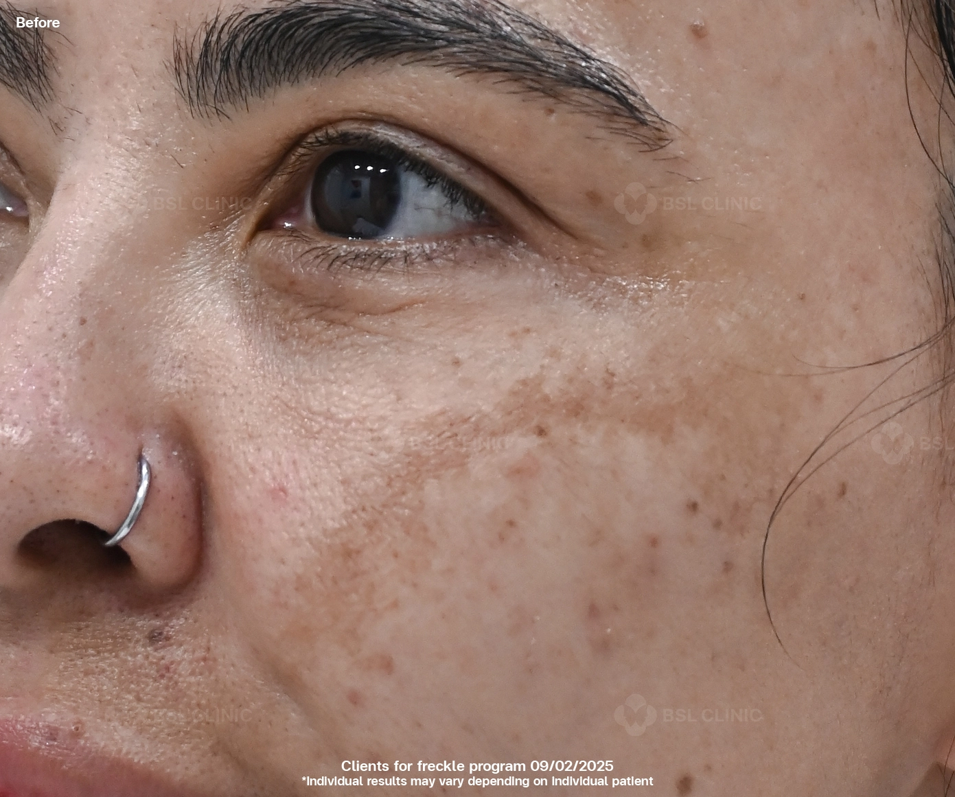 Before result Frekle