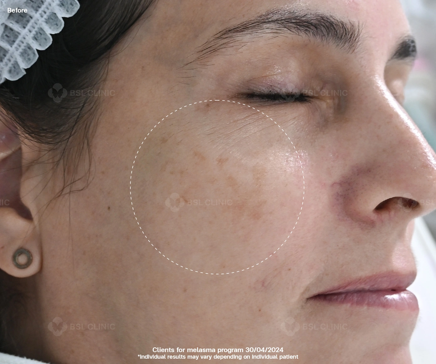 Before result melasma