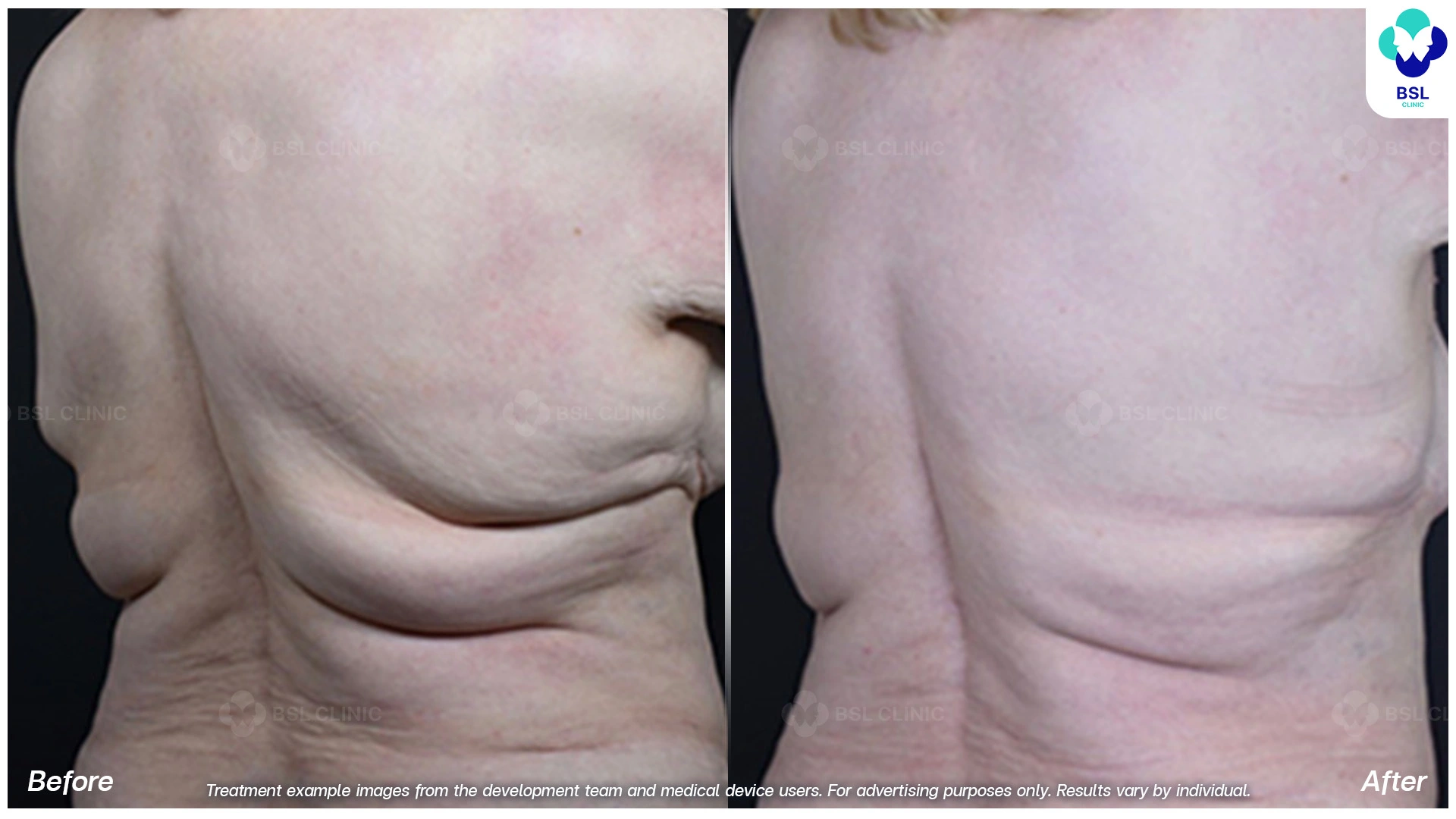 upper back and lower back fat reduction before and after 8 weeks coolsculpting treatment visual contour change in older woman