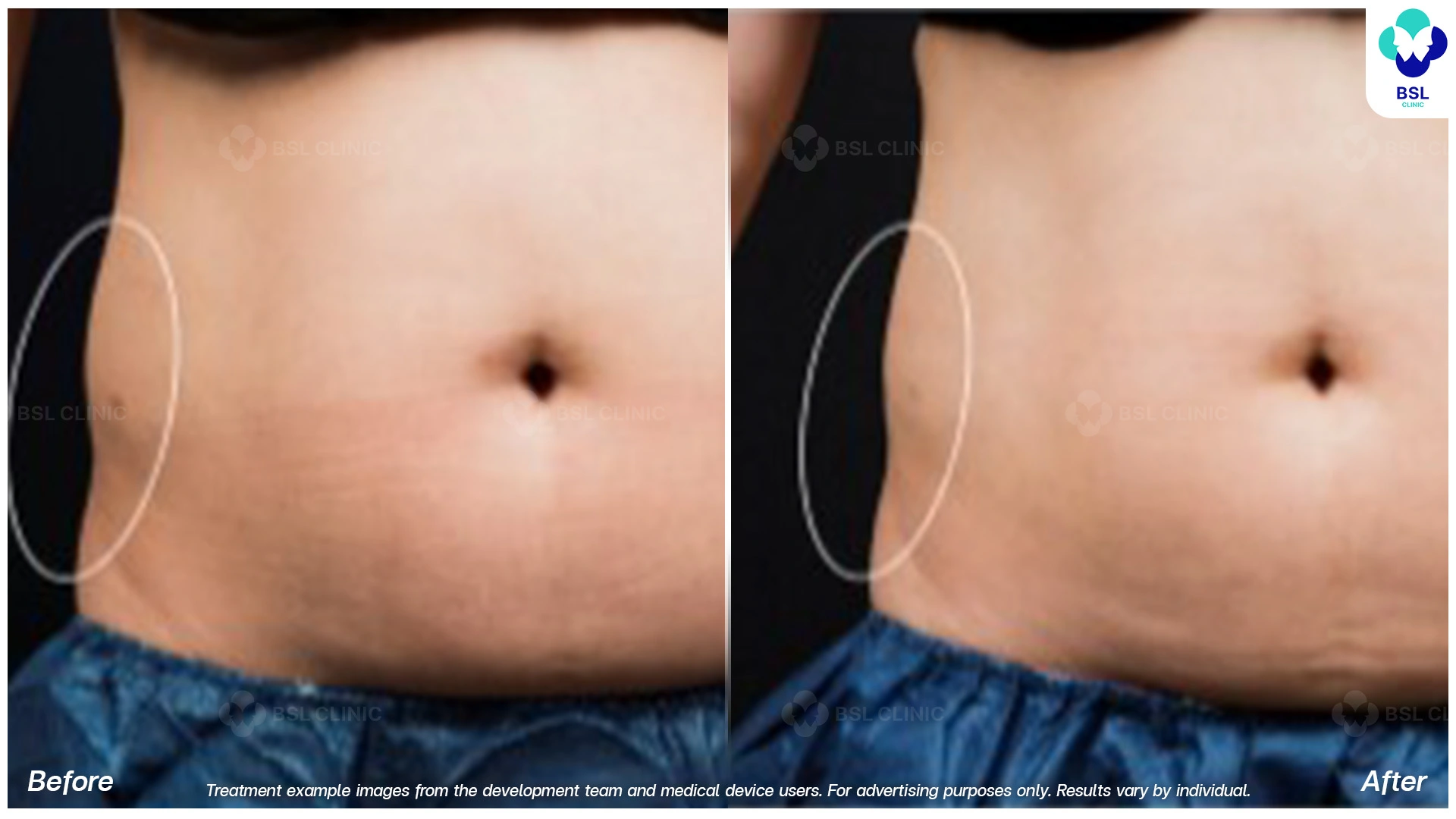 flank fat reduction before and after front and back views 12 weeks cryolipolysis body contouring for love handles