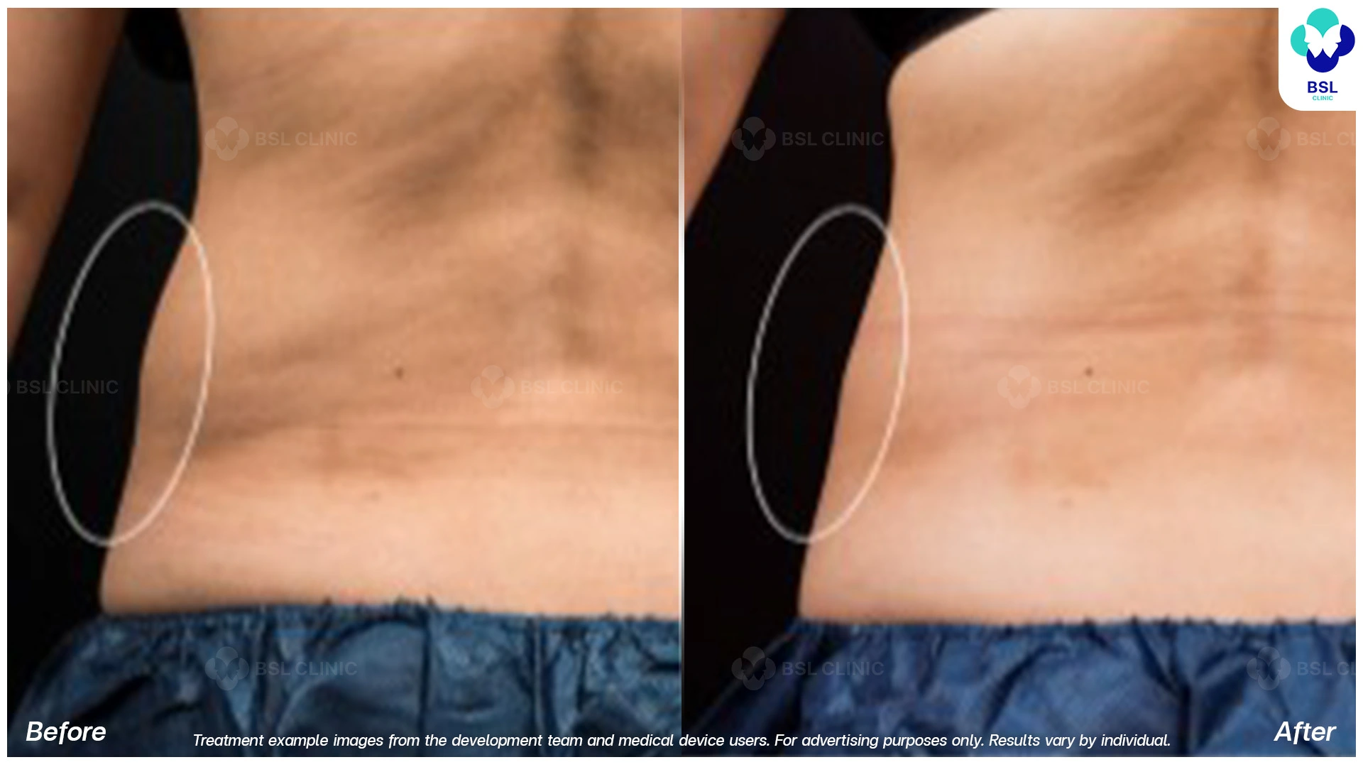 flank fat reduction before and after front and back views 12 weeks cryolipolysis body contouring for love handles