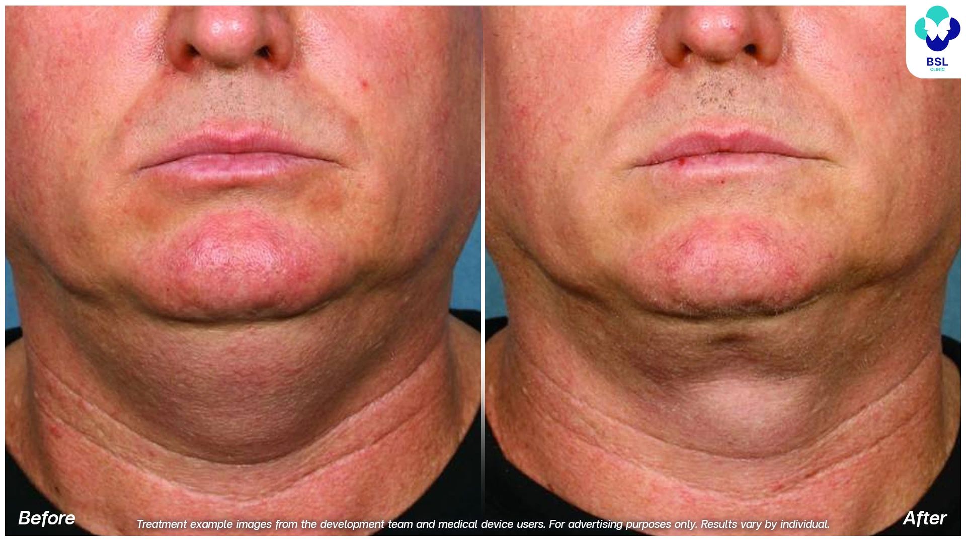before and after fat freezing double chin treatment coolshaping2 program submental cryolipolysis side profile results