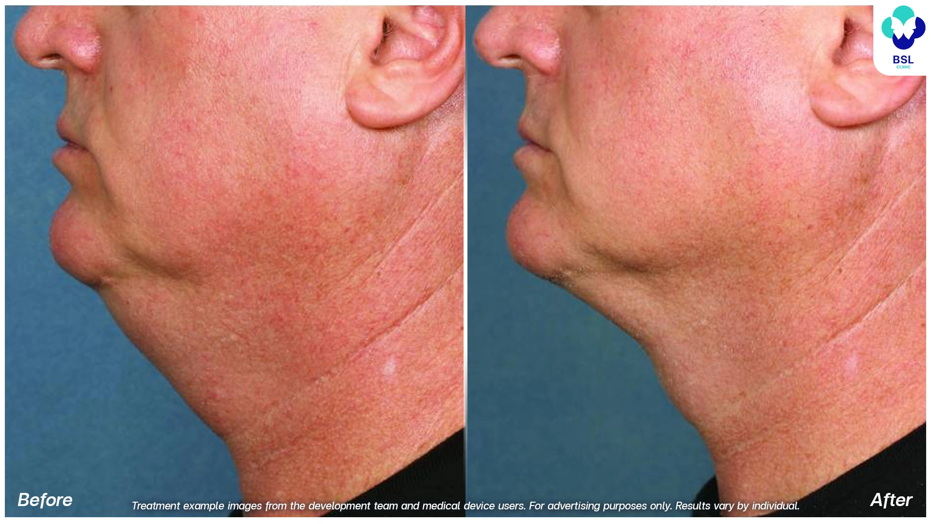 before and after fat freezing double chin treatment coolshaping2 program submental cryolipolysis side profile results