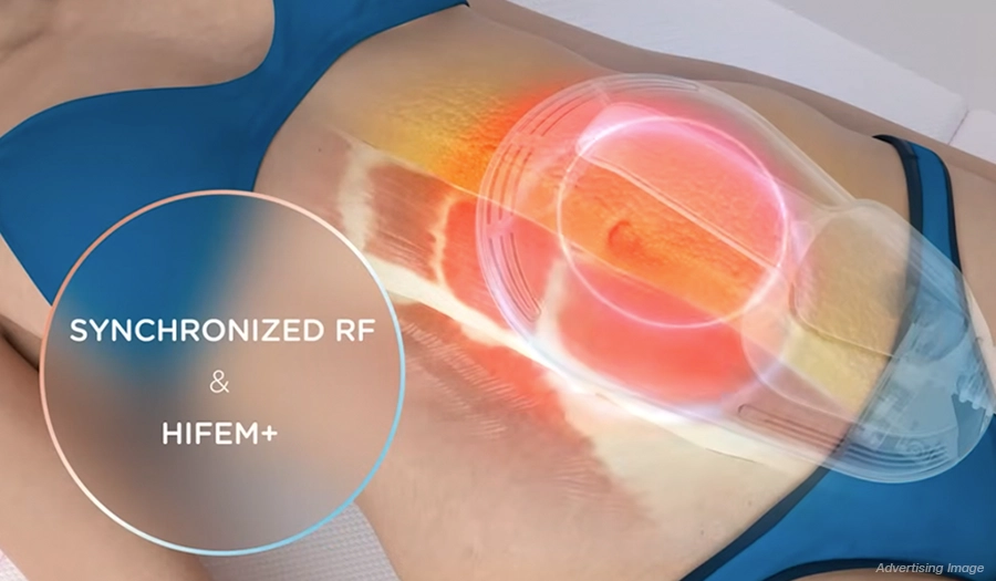EMSculpt Neo radiofrequency warms the tissue to support fat reduction and prepare muscles for treatment