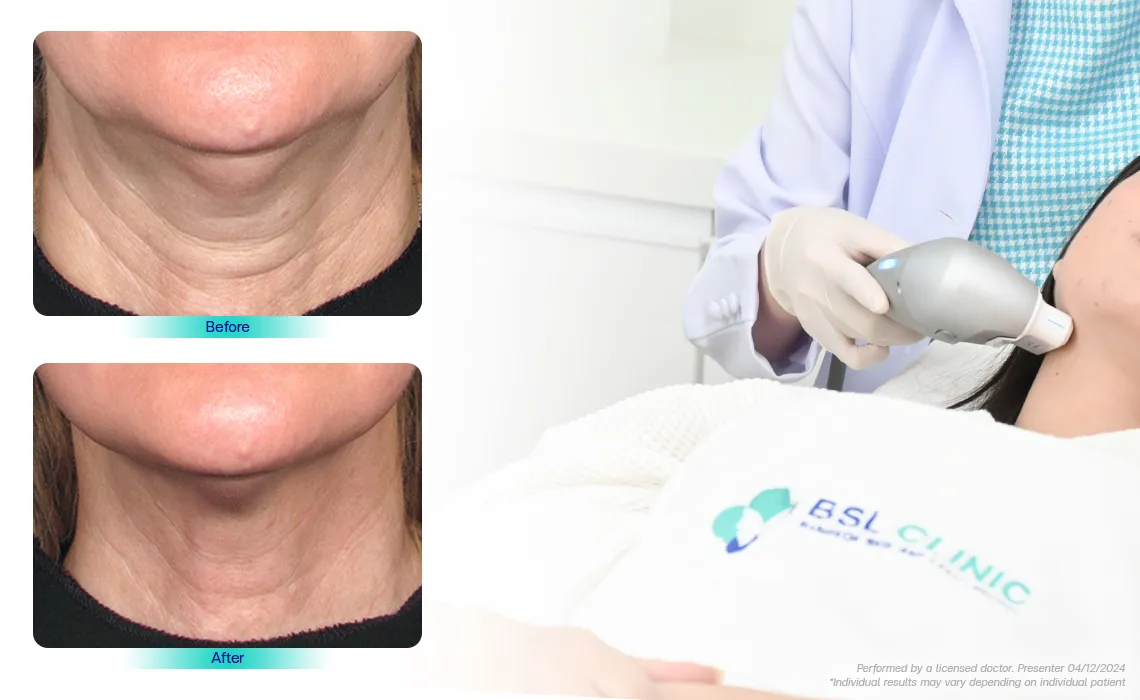 Excess-Layers-of-Fat-on-the-Neck