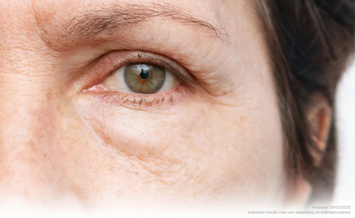 Eye Bag Grooves Underneath the Eyes