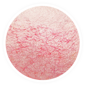 Facial-Redness-(Rosacea)