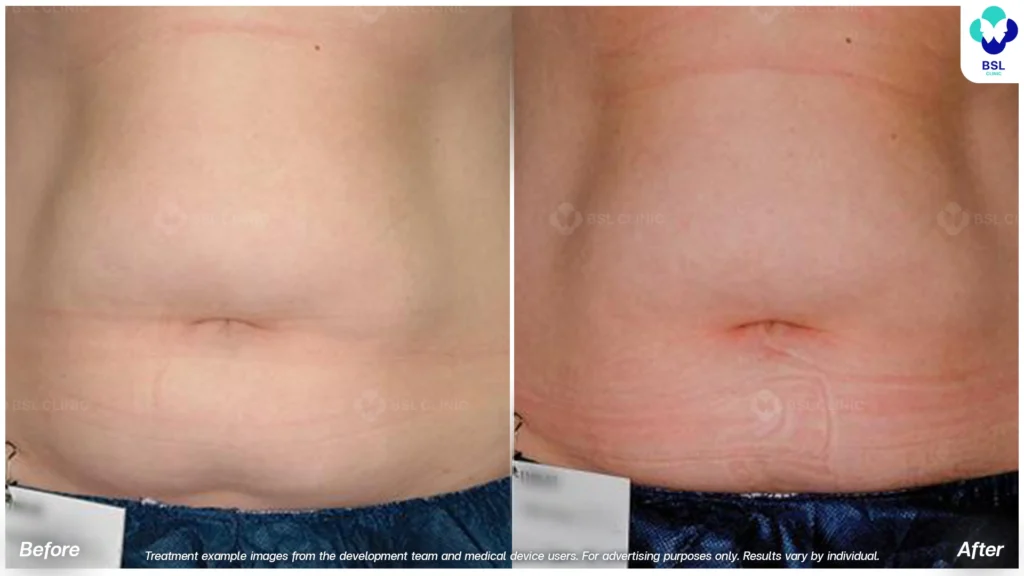 result Fat Removal
