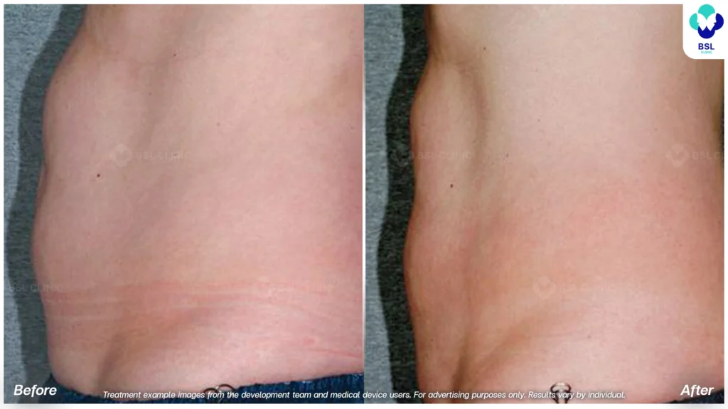 result Fat Removal