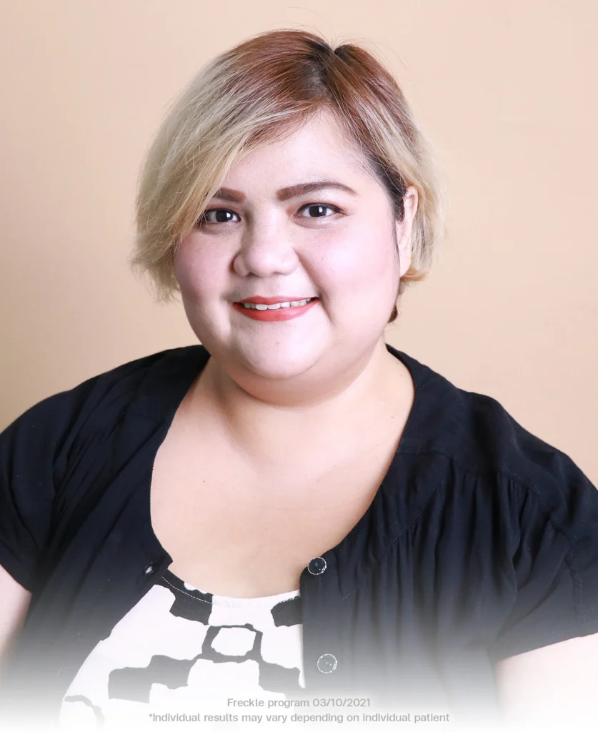 ms puti freckles horis nevus sun spots dark spots solar lentigines clear skin treatment bangkok bsl clinic