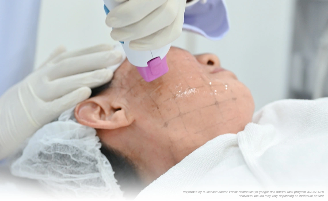 thermage flx face lift for thinning skin loose cheeks and upper eyelid lifting