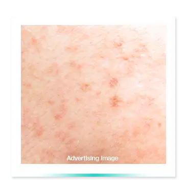 Frackles horis nevus